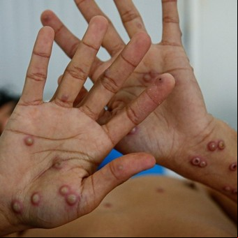 Detectan siete nuevos casos de viruela del mono en Argentina: la mayoría es de la Ciudad de Buenos Aires