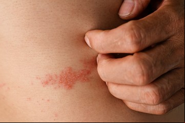 Herpes Zóster: cómo se reactiva el virus de la varicela y qué deben saber los mayores de 50 años
