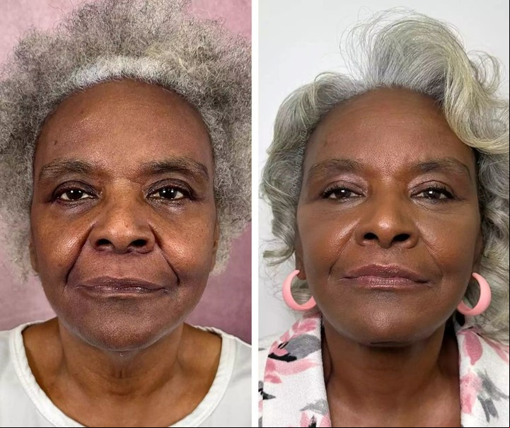 El antes y después del estiramiento facial. Foto: Carl M. Truesdale/@doctor.truesdale.